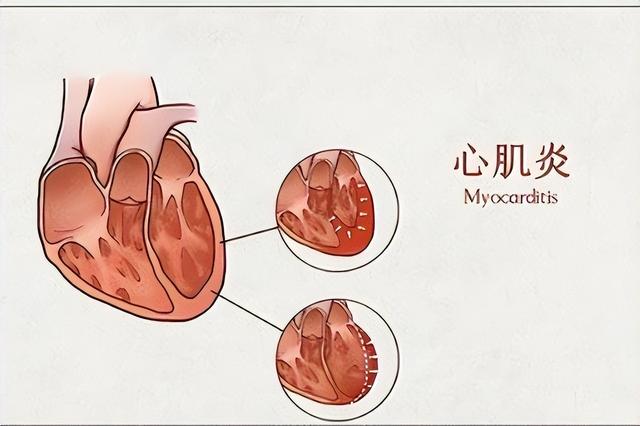 心肌炎的癥狀有哪些？心肌炎的主要變現癥狀有啥？